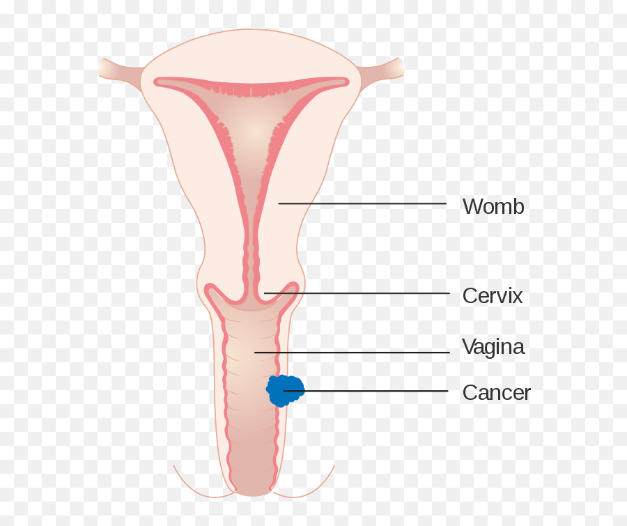 Diagram Showing Stage 2 Vaginal Cancer Cruk 210 - Stage 2 Vulva Cancer Emoji,Leg Emoji