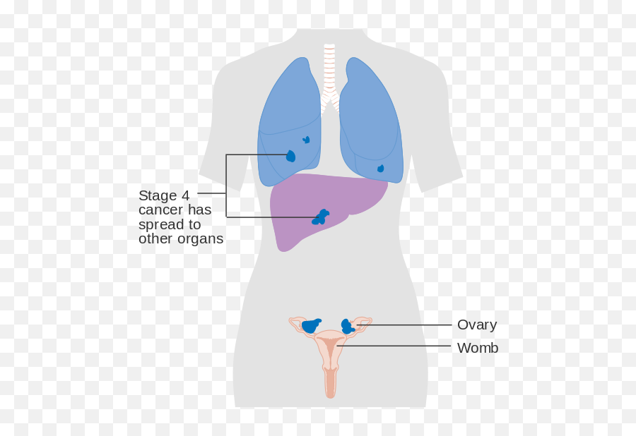 Stage 4 Ovarian Cancer Cruk 233 - Figo Ovarian Cancer Staging 2019 Emoji,Emoji Zodiac Signs Meaning