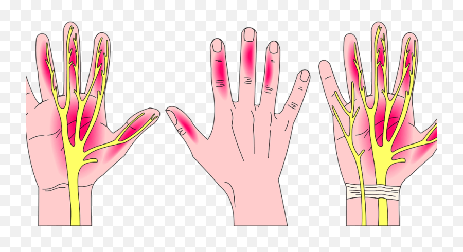 How I Fixed My Carpal Tunnel Pain - Hoi Chng Ong Co Tay Emoji,Raising Hand Emoji Copy And Paste