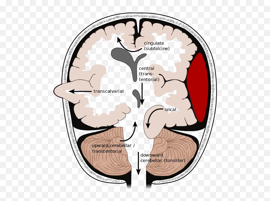 Brain Herniation - Types Of Brain Herniation Emoji,Brain Emoji Iphone