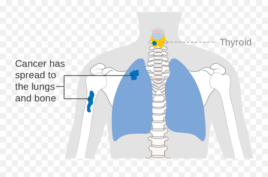Diagram Showing Stage M1 Thyroid Cancer Cruk - Diagram Emoji,Ticket Emoji