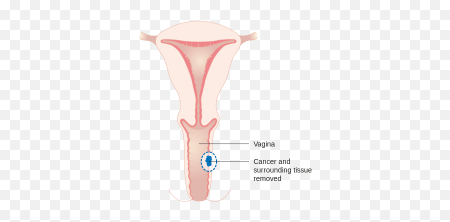 Diagram Showing A Wide Local Excision For Vaginal - Vaginal Wide Excision Emoji,Ticket Emoji