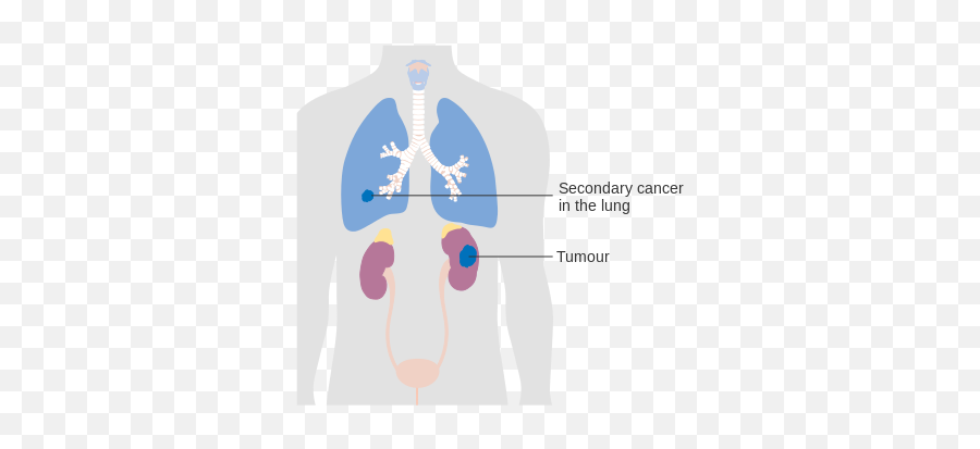 Diagram Showing Stage 4 Kidney Cancer Cruk 231 - Stage 4 Kidney Cancer Emoji,Ticket Emoji