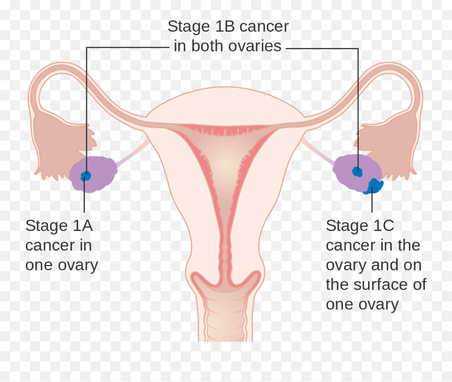 Diagram Showing Stage 1 Ovarian Cancer Cruk 193 - Figo Staging Ovarian Cancer Diagram Emoji,Ticket Emoji