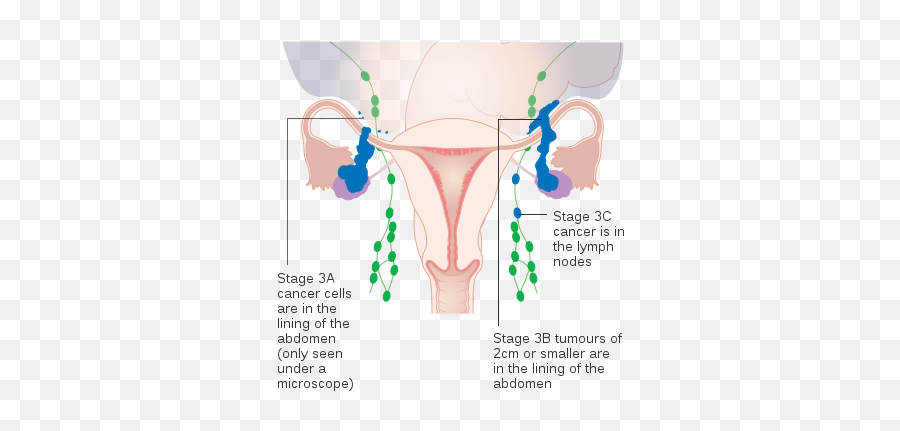 Diagram Showing Stage 3a To 3c Ovarian Cancer - Figo Staging Ovarian Cancer Diagram Emoji,Ticket Emoji