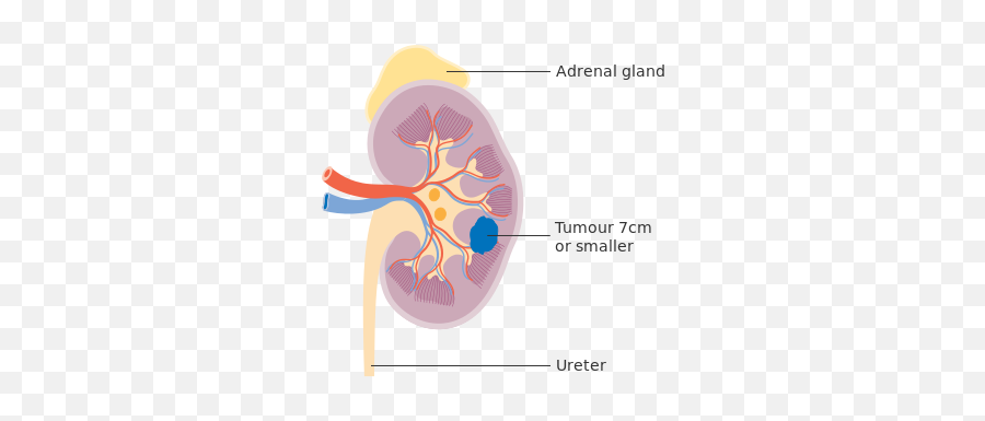 Diagram Showing Stage 1 Kidney Cancer Cruk 192 - Illustration Emoji,Ticket Emoji