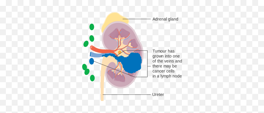 Diagram Showing Stage 3 Kidney Cancer Cruk 222 - Kidney Cancer Stage Symptom Emoji,Ticket Emoji