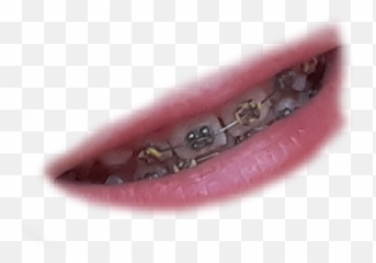 Largest Collection of Free - toEdit braceface Stickers Canine Tooth Emoji