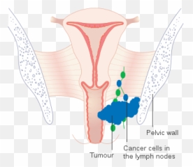 Diagram Showing Stage 3 Vaginal Cancer Cruk 223 - Illustration Emoji,Octopus Emoji