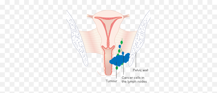 Diagram Showing Stage 3 Vaginal Cancer Cruk 223 - Illustration Emoji,Octopus Emoji