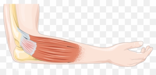 Tendon Inflammation - La Tendinite En Arabe Emoji,Blood Type Emoji