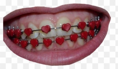 braces PNG and vectors for Free Download - DLPNGcom Mouth With Braces Png Emoji