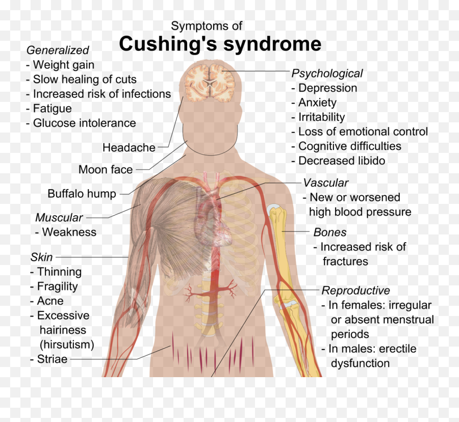 Cushings Syndrome - Cushing Syndrome Emoji,Weight Loss Emoji