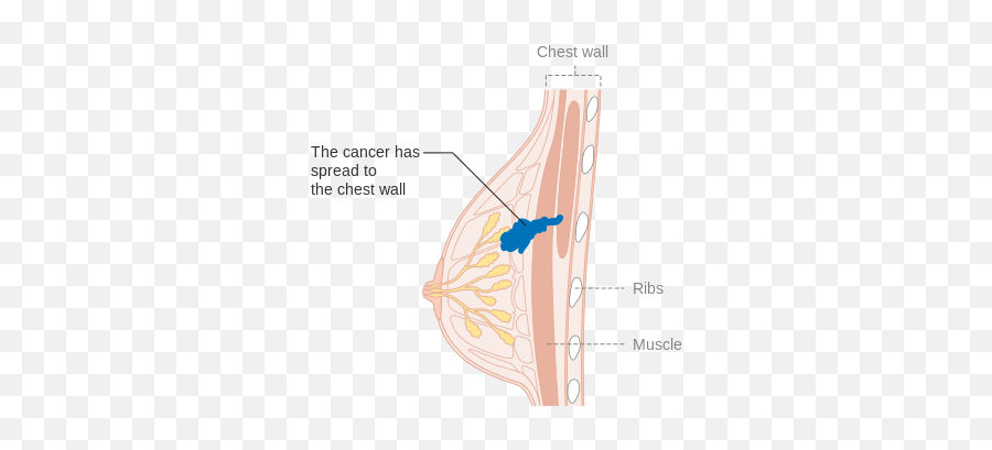 Stage 3b Breast Cancer Cruk 004 - Breast Cancer Line Diagram Emoji,Breast Cancer Emoji