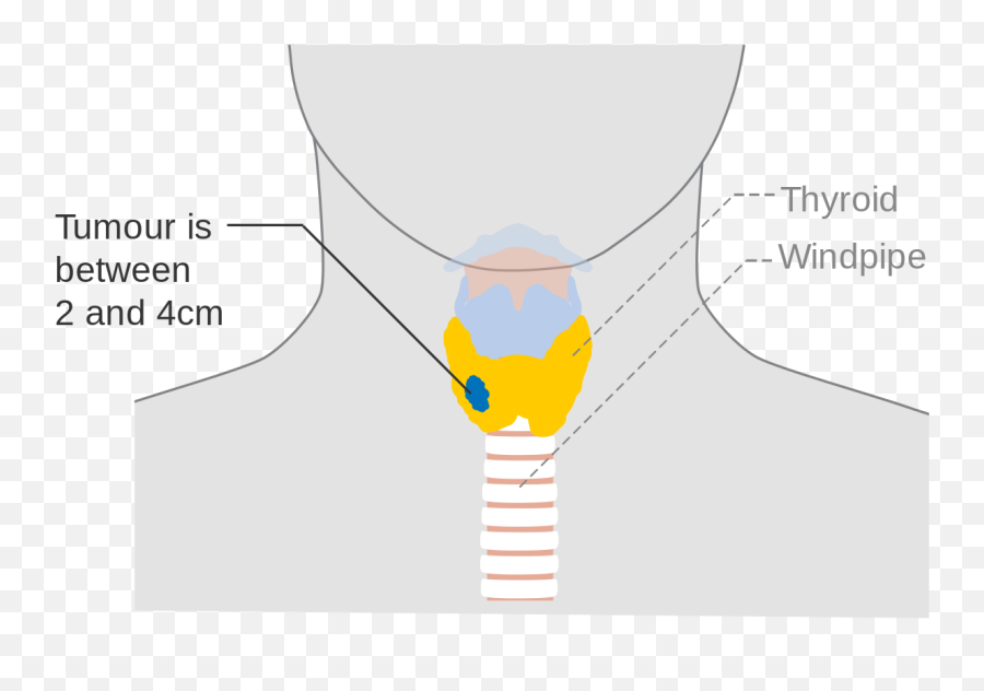Stage T2 Thyroid Cancer Cruk 258 - Diagram Emoji,Necklace Emoji