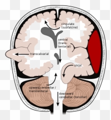 Brain Herniation Types - Emoji