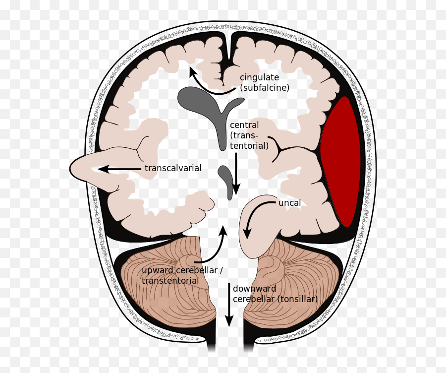 Brain Herniation Types - Brain Herniation Emoji,What Do Android Emojis Mean