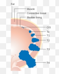 Diagram Showing The Stages Of Bladder Cancer Cruk 372 - Staging Emoji