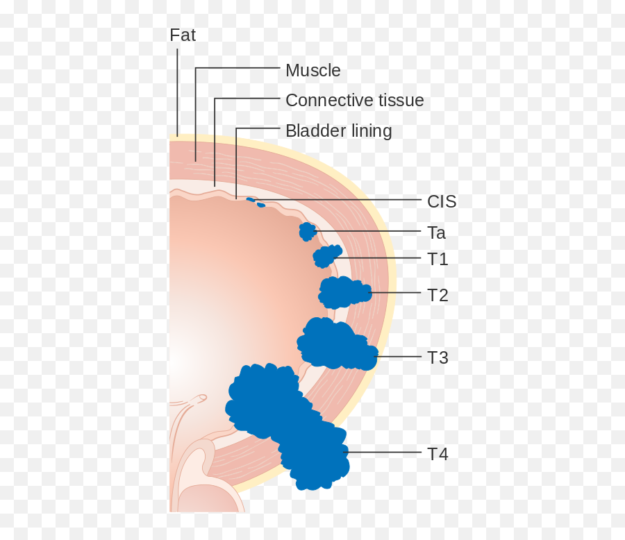 Diagram Showing The T Stages Of Bladder Cancer Cruk 372 - Bladder Cancer Staging Emoji,Emojis Are Cancer