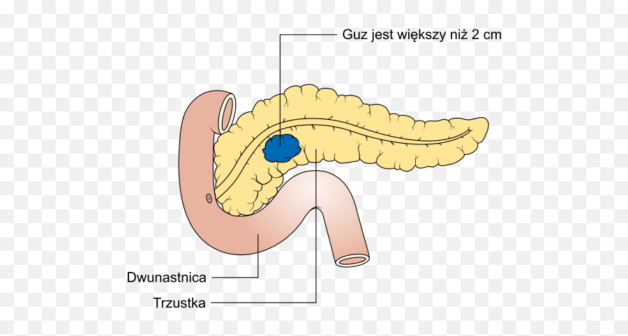 Diagram Showing Stage T2 Cancer Of The Pancreas Cruk - Rak Trzonu Trzustki Emoji,Emojis Are Cancer