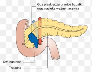 Diagram Showing Stage T4 Cancer Of The Pancreas Cruk - Pancreas Diagram Png Emoji,Emojis Are Cancer