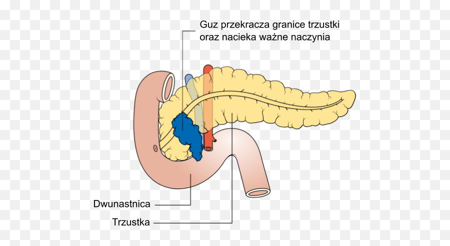 Diagram Showing Stage T4 Cancer Of The Pancreas Cruk - Pancreas Diagram Png Emoji,Emojis Are Cancer