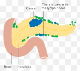 Diagram Showing Pancreatic Cancer In The Lymph Nodes - Oral Microbiome And Risk Emoji