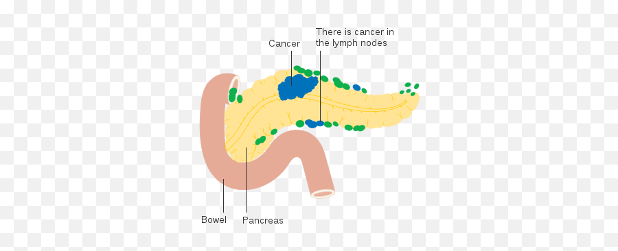 Diagram Showing Pancreatic Cancer In The Lymph Nodes - Oral Microbiome And Cancer Risk Emoji,Emojis Are Cancer