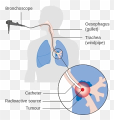 Diagram Showing How You Have Internal Radiotherapy For - Lung Cancer Radiation Therapy Emoji