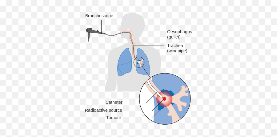 Diagram Showing How You Have Internal Radiotherapy For - Lung Cancer Radiation Therapy Diagram Emoji,Emojis Are Cancer