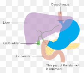 Diagam Showing The Anatomy Before Roux - Cruk Stomach Cancer Svg Emoji