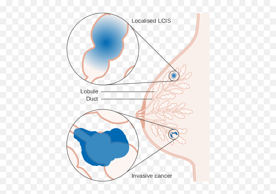 Diagram Showing Lobular Carcinoma In Situ Cruk - Ductal Carcinoma In Situ Vs Lobular Carcinoma Emoji,Emojis Are Cancer