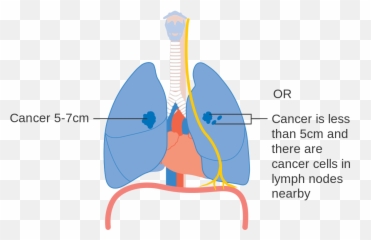 Diagram Showing Stage 2a Lung Cancer Cruk 213 - Stages Emoji