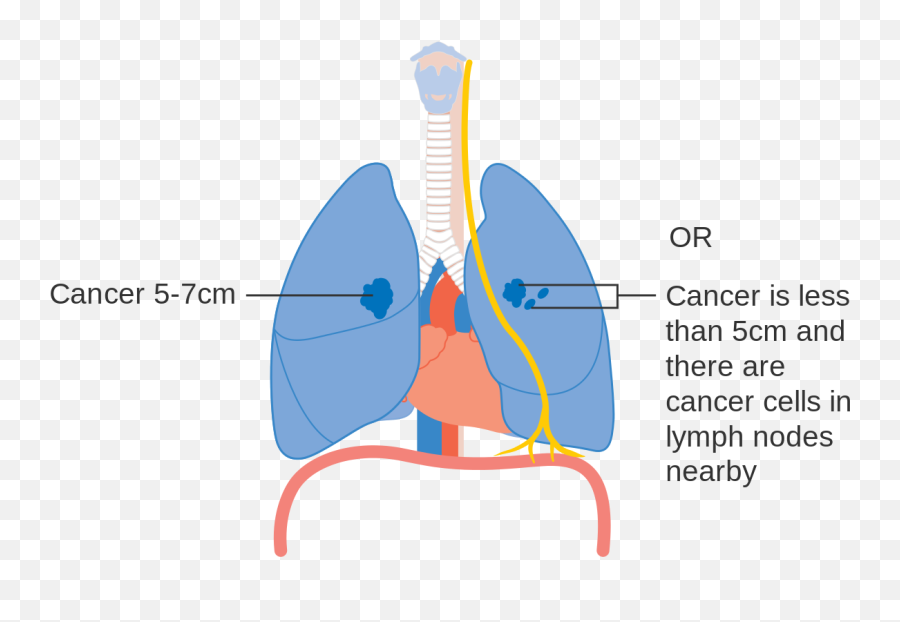 Diagram Showing Stage 2a Lung Cancer Cruk 213 - Lung Cancer Stages Diagram Emoji,Emojis Are Cancer