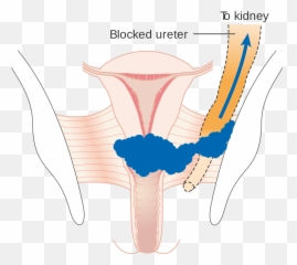 Diagram Showing Stage 3b Cervical Cancer Cruk 226 - Clinical Features Of Emoji