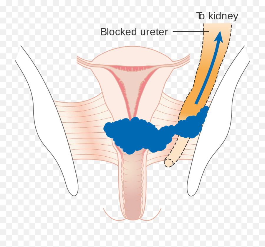 Diagram Showing Stage 3b Cervical Cancer Cruk 226 - Clinical Features Of Cervical Cancer Emoji,Emojis Are Cancer