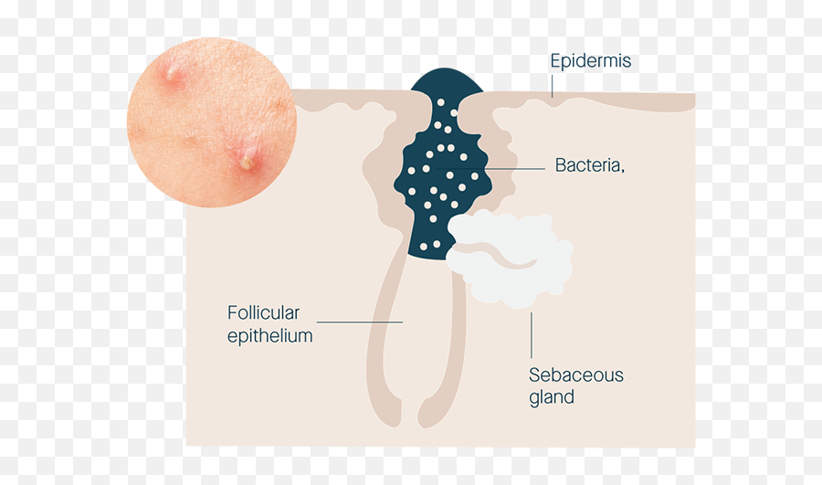 Sensitive Skin Acne System - Dot Emoji,Meaning Of The Peach Emoji