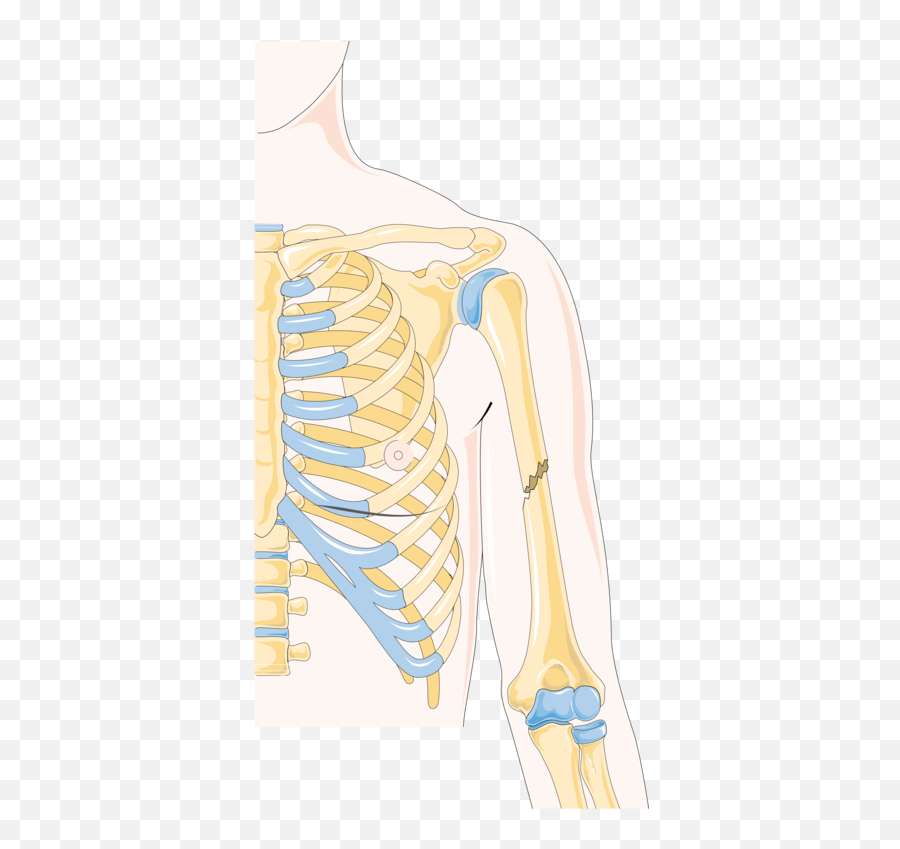 Upper Arm Bone Fracture - Humerus Fracture Emoji,Broken Bone Emoji