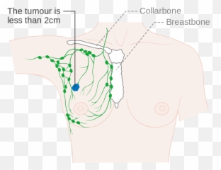 Diagram Showing Stage 1a Breast Cancer Cruk 199 - 1b Emoji