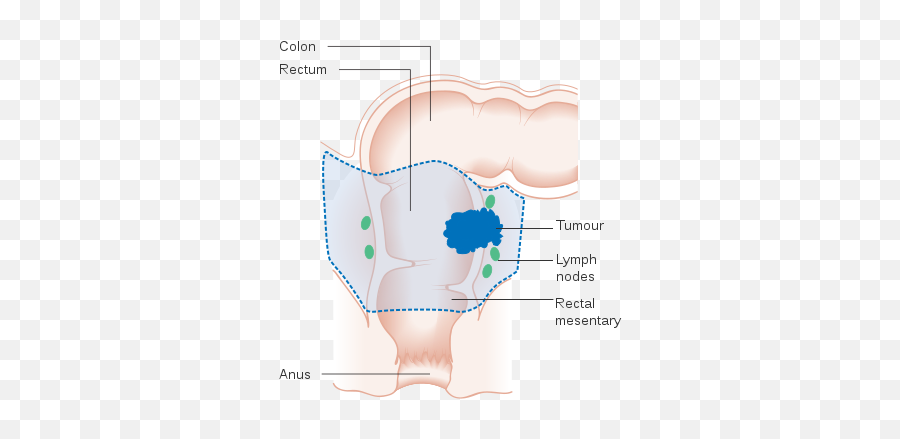 Diagram Showing The Area Removed For A Rectal Cancer - Rectum Cancer Emoji,Emojis Are Cancer