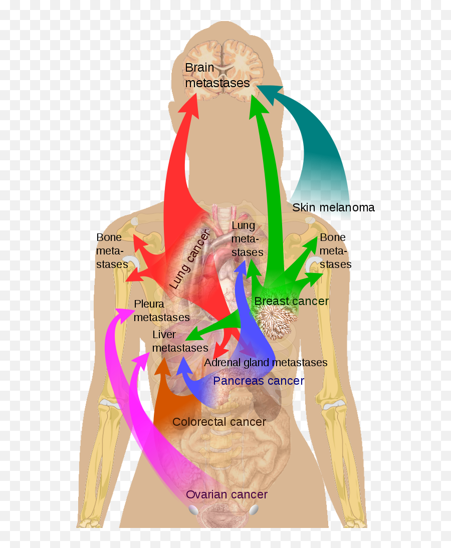 Metastasis Sites For Common Cancers - Common Sites Of Metastasis Emoji,Emojis Are Cancer