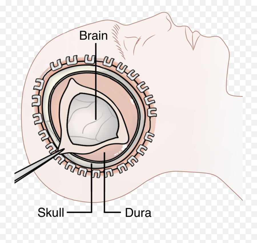 Decompressive Craniectomy - Craniectomy Emoji,Skull Water Skull Emoji