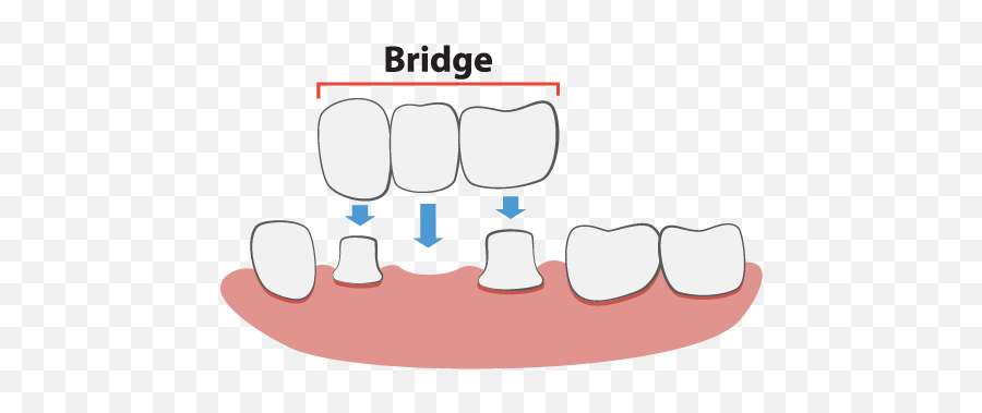 Tongue Clip Temporary Transparent Png - Dental Bridge Illustration Emoji,Missing Tooth Emoji