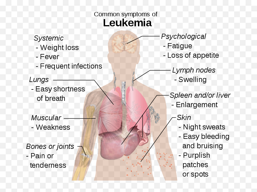Symptoms Of Leukemia - Symptoms Of Leukemia Emoji,Joint Emoji Copy And Paste