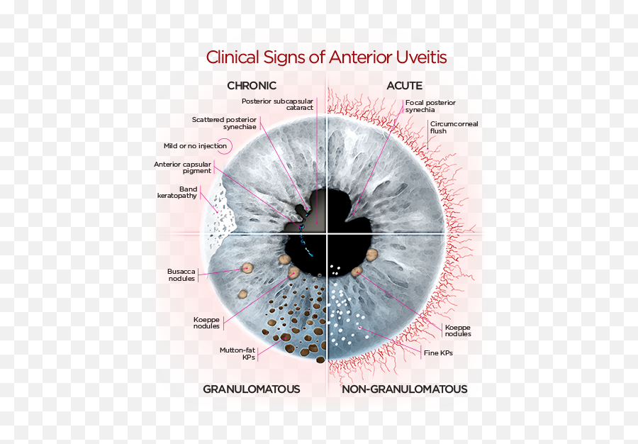 Eye Anatomy - Clinical Signs Of Anterior Uveitis Emoji,Eyes Squiggly Lines Emoji