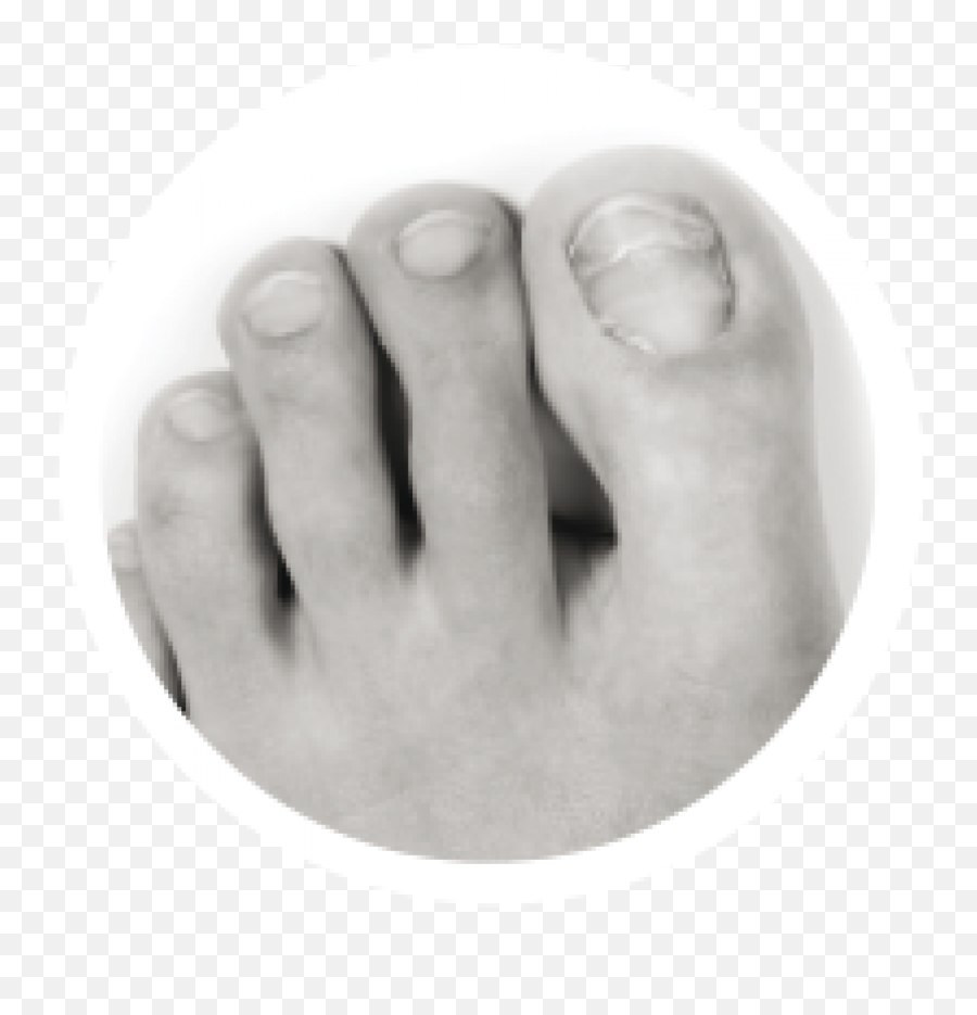 Athleteu0027s Foot And Fungal Nail Conditions U2013 Dalkey Podiatry - Toe Emoji,Foot Emoticon