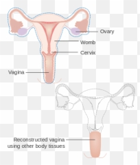 Diagram Showing A Radical Hysterectomy With A - Hysterectomy Diagram Emoji,Swim Emoji