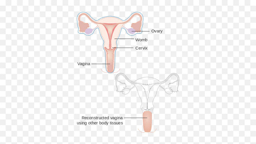 Diagram Showing A Radical Hysterectomy With A - Hysterectomy Diagram Emoji,Swim Emoji