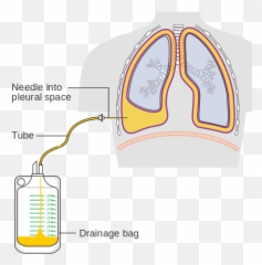 Pleural Effusion Is Drained Cruk 456 - Pleural Drainage Emoji,Space Needle Emoji