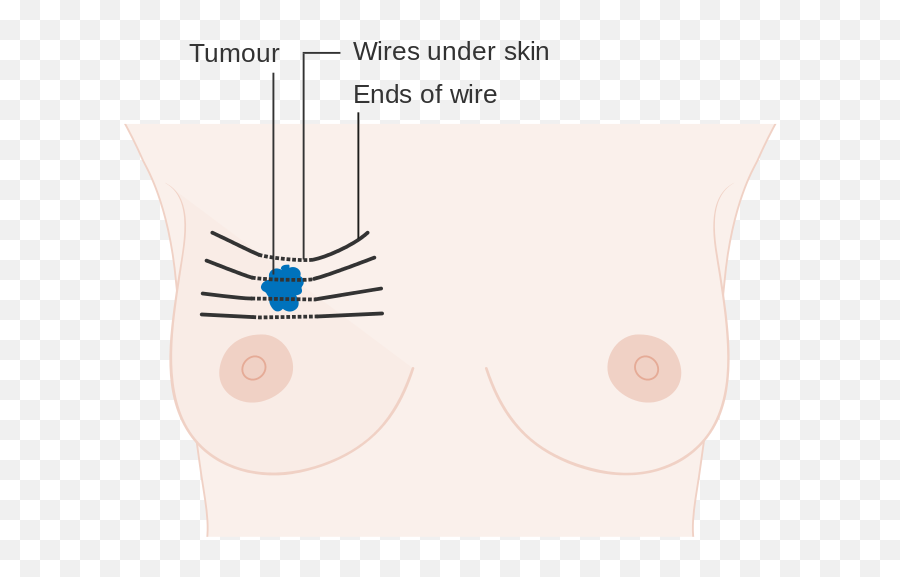 Have Internal Radiotherapy - Diagram Emoji,Breast Cancer Emoji